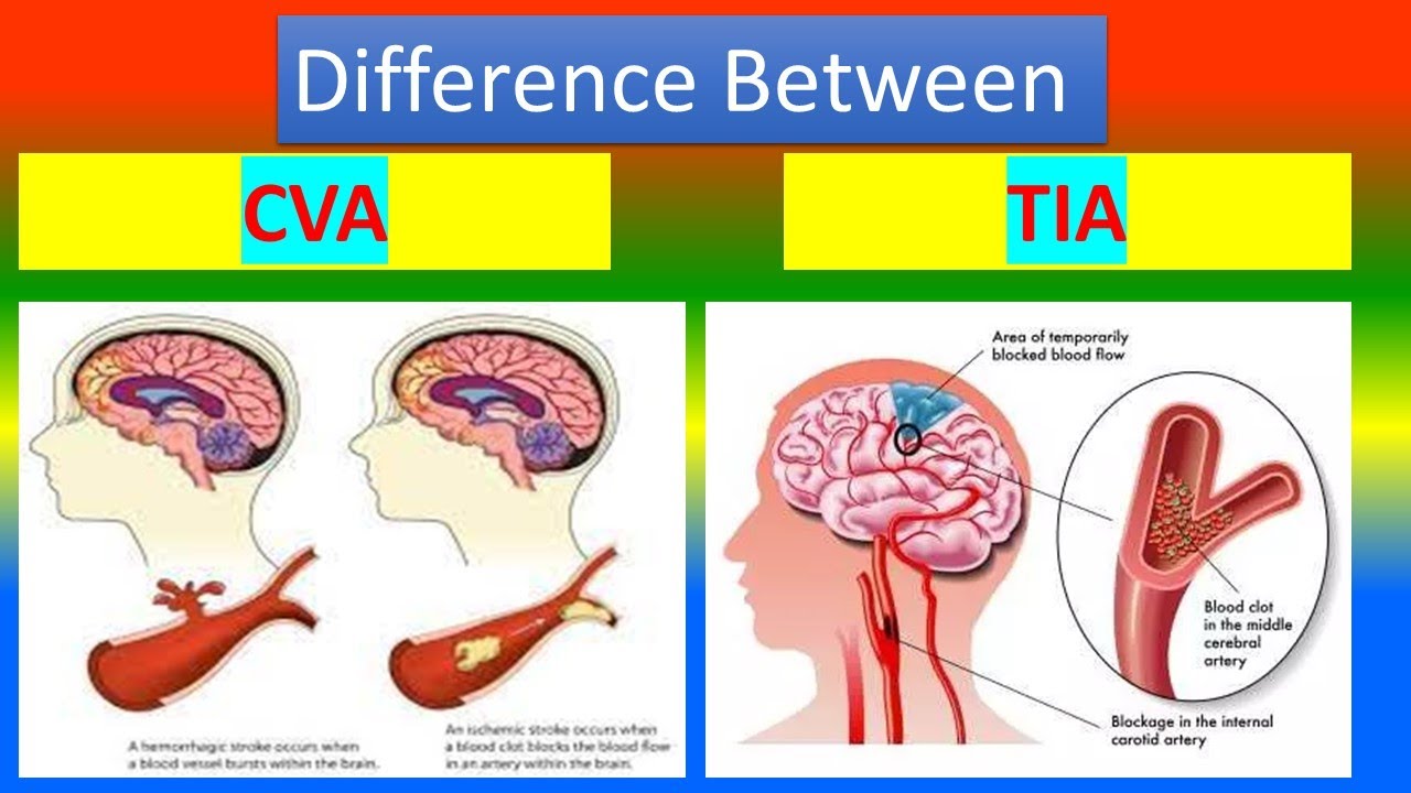 Cva medical abbreviation