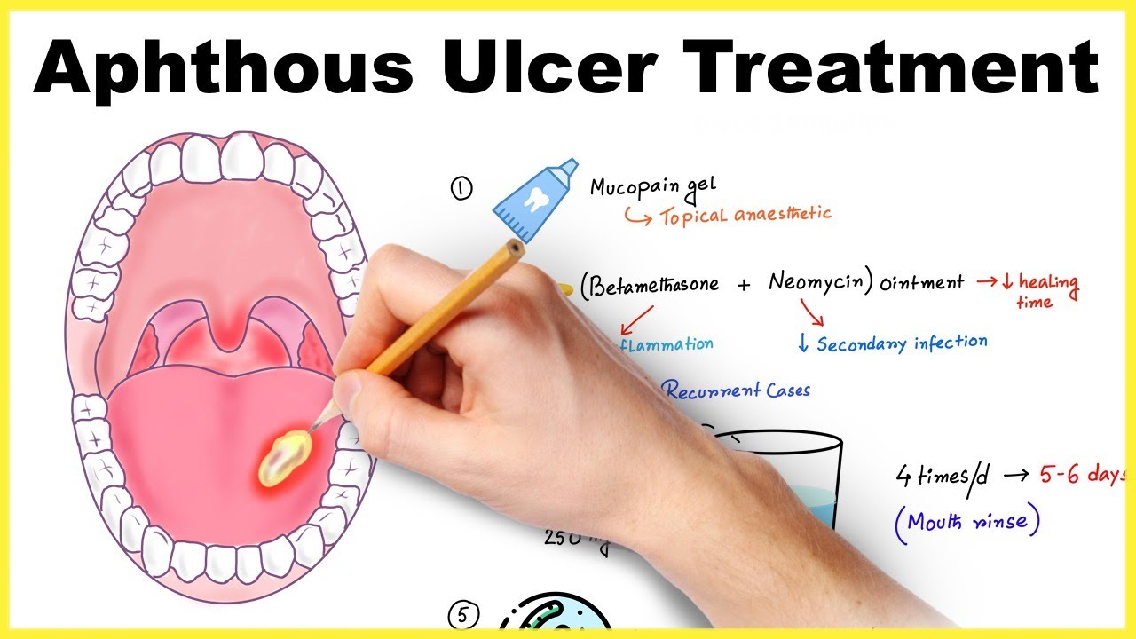 Aphthous ulcer medication